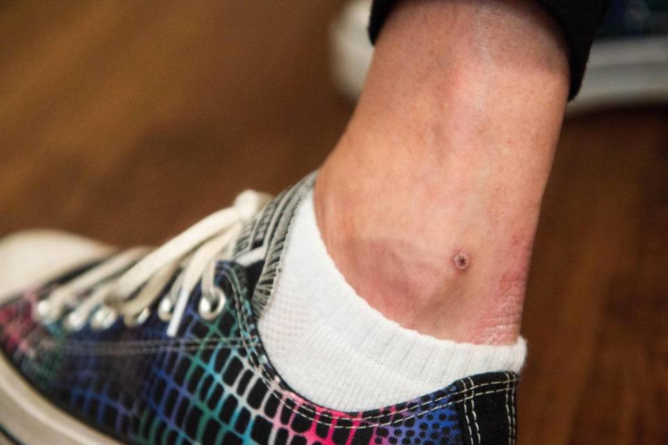 A faint scab remains on an ankle of Suzanne Forbes, who had a painful case of shingles over Memorial Day weekend.