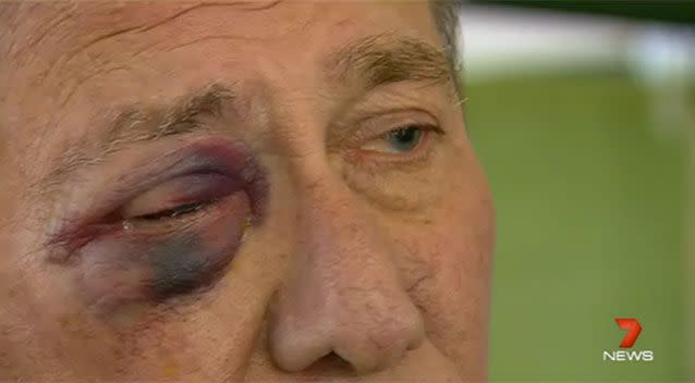 John's broken eye socket. Source: 7 News