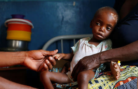 Kaba Bitika Marie, 19 months, an internally displaced and severely acute malnourished child receives medical attention at the Presbyterian hospital in Dibindi zone of Mbuji Mayi in Kasai Oriental Province in the Democratic Republic of Congo, March 16, 2018. REUTERS/Thomas Mukoya/Files