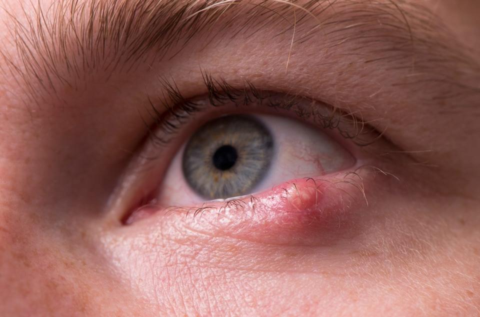 Close up of an eye with a stye on the lower lid