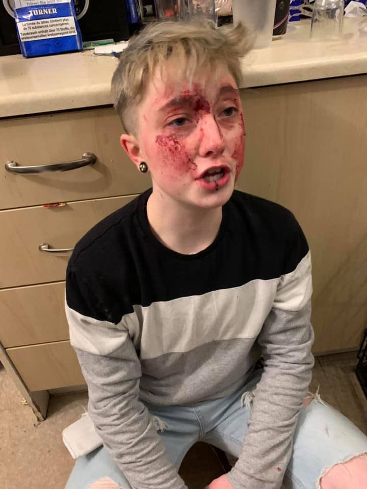 UK lesbian Charlie Graham sitting on her floor with injuries to her face.