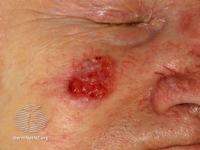 <p>https://dermnetnz.org/topics/squamous-cell-carcinoma-on-the-face-images/?stage=Live</p> Squamous Cell Carcinoma
