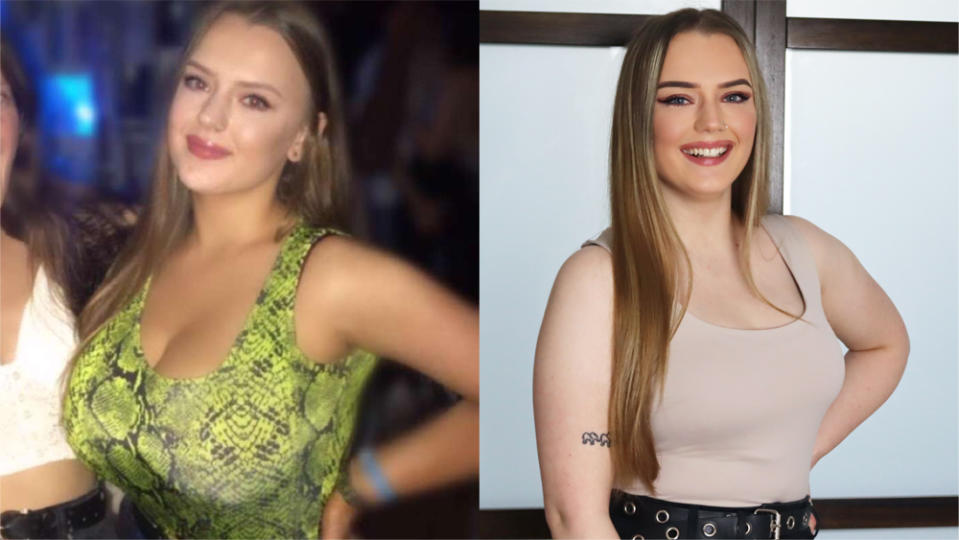 Amber Roach before and after her breast reduction. (PA Real Life/Alex Fobbester)