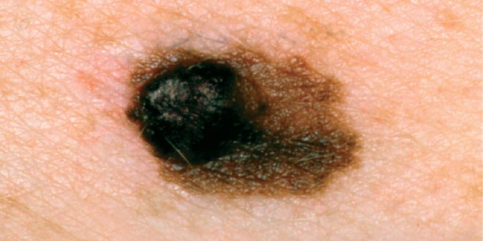 picture of asymmetrical melanoma (Courtesy The Skin Cancer Foundation)