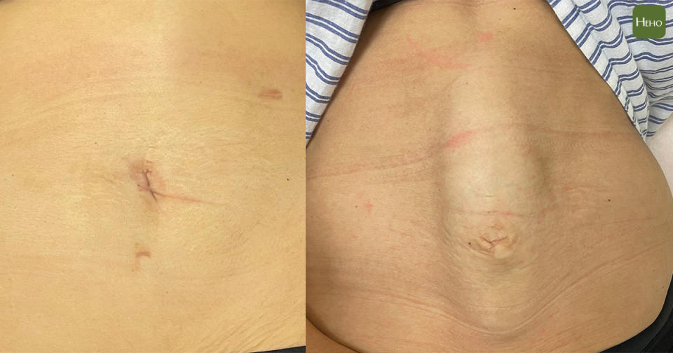 患者術後腹直肌分離情況，右圖為未手術，左圖為手術後。圖片提供：王凱緯醫師