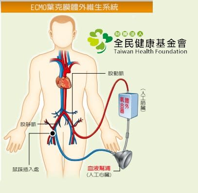 葉克膜是血液幫浦及體外氧合器的組合,導管可由鼠膝部或頸部、腋下等部位插入,連接血管將血液引流至體外,經氣體交換後再送回體內,可暫時輔助人體心肺功能。