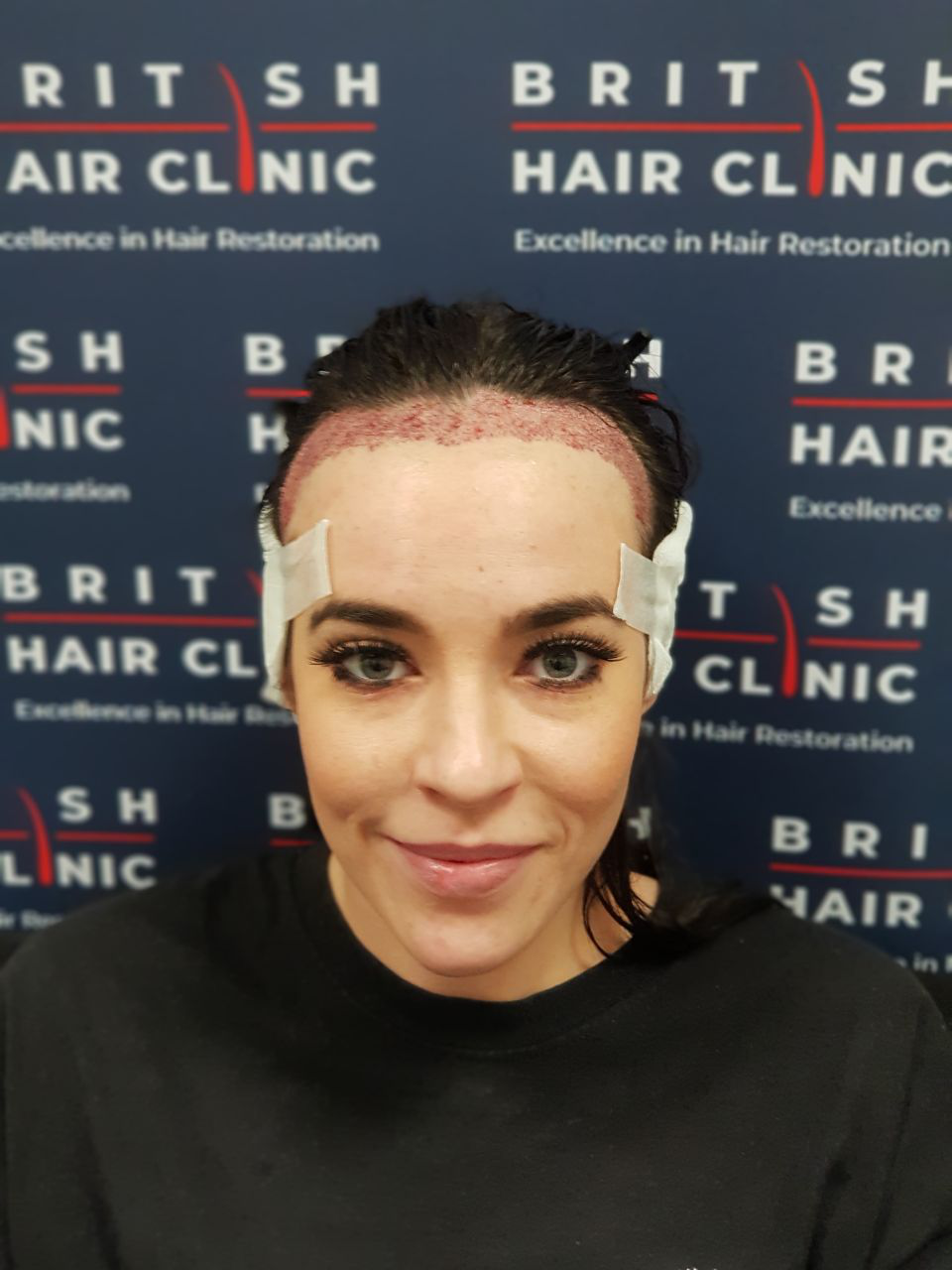 Stephanie Davis underwent a hair transplant. [Photo: British Hair Clinic]