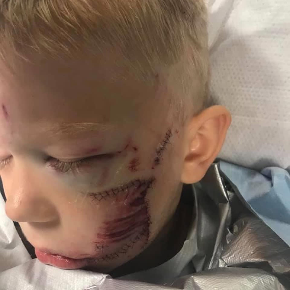 Bridger Walker after receiving stitches. (Courtesy Walker family)