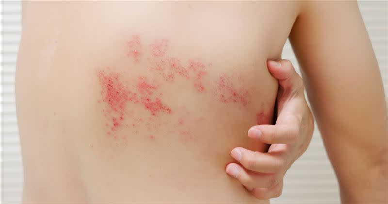 帶狀疱疹引發難以忍受的神經痛，又被稱為「百痛之王」。（圖／Shutterstock）