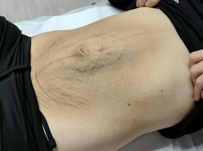 Diástasis Abdominal: Abombamiento de la línea alba por aumento de presión.