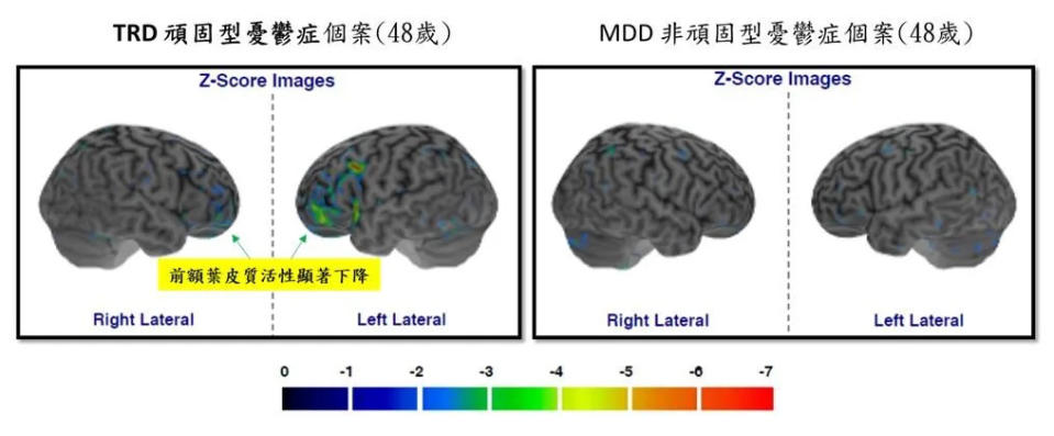 <strong>北榮最新研究發現，頑固型憂鬱症患者的一等親，大幅增加9.16倍罹患頑固型憂鬱症的風險，也增加了2至3倍得到其他精神疾病的機會。（圖／台北榮總提供）</strong>