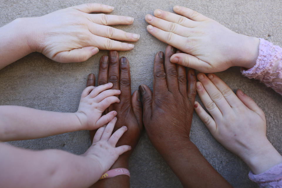 Joyce Muchenje, centre, places her hands on a wall and that of her three children, who all have albinism, outside their family home in Chitungwiza on the outskirts of Harare, in this Tuesday, June, 9, 2020 photo. Muchenje used to provide for them by washing laundry and household cleaning for cross border traders at a busy border town before the lockdown, but now the border trade has stopped and Mutenje has run out of money to get the skin cream for her children. (AP Photo/Tsvangirayi Mukwazhi)