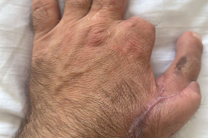 Marcin Michalec's left hand after the toe-to-thumb transplant