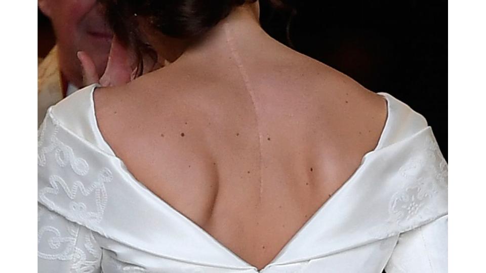 Princess Eugenie has a scar from back surgery