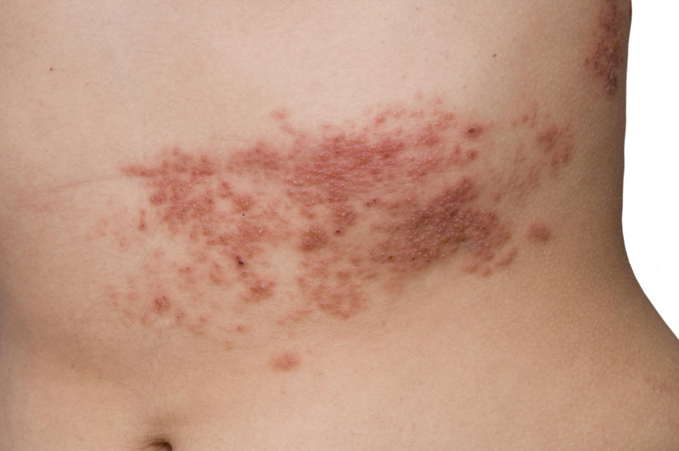 A painful rash that turns into blisters occur during a shingles flare-up. (Image via Getty Images)