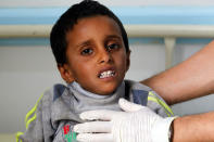 <p>A Yemeni child suspected of being infected with cholera receives treatment at a hospital in Sana’a, Yemen on June 15, 2017. (Yahya Arhab/EPA/REX/Shutterstock) </p>