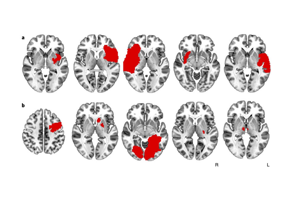 Una ilustración sin fecha proporcionada por Joutsa, Fox et al., Nature Medicine 2022 muestra en color rojo las lesiones cerebrales asociadas a la remisión de la adicción. (Joutsa, Fox et al., Nature Medicine 2022 vía The New York Times)