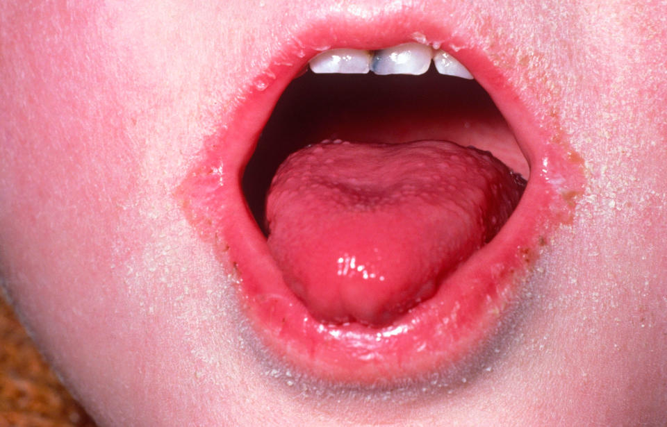 Strep A can cause the skin infection impetigo, scarlet fever and strep throat. (PA/Alamy)