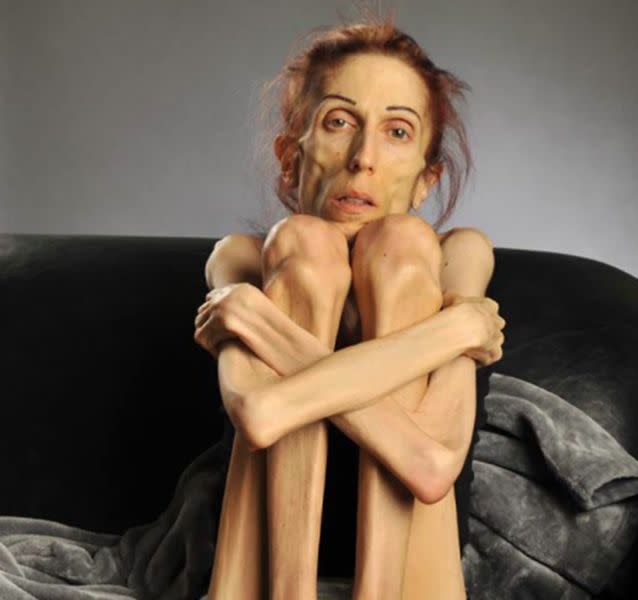 Rachael Farrokh has battled anorexia for 10 years. Source: Facebook/ Rachel's road to recovery.