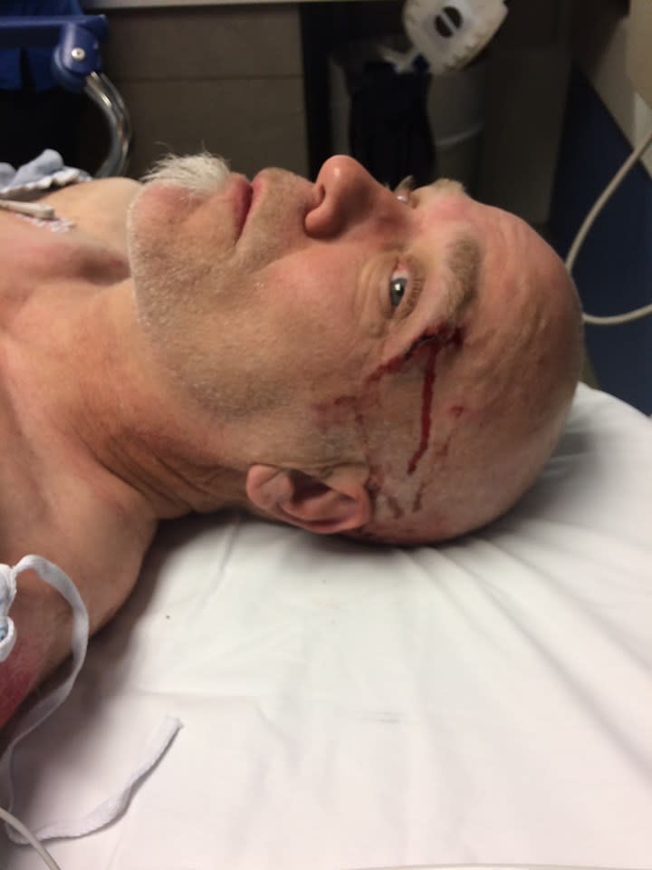 Bob Burdett in hospital after falling his mountain bike. A bleeding wound is seen above his eyebrow.