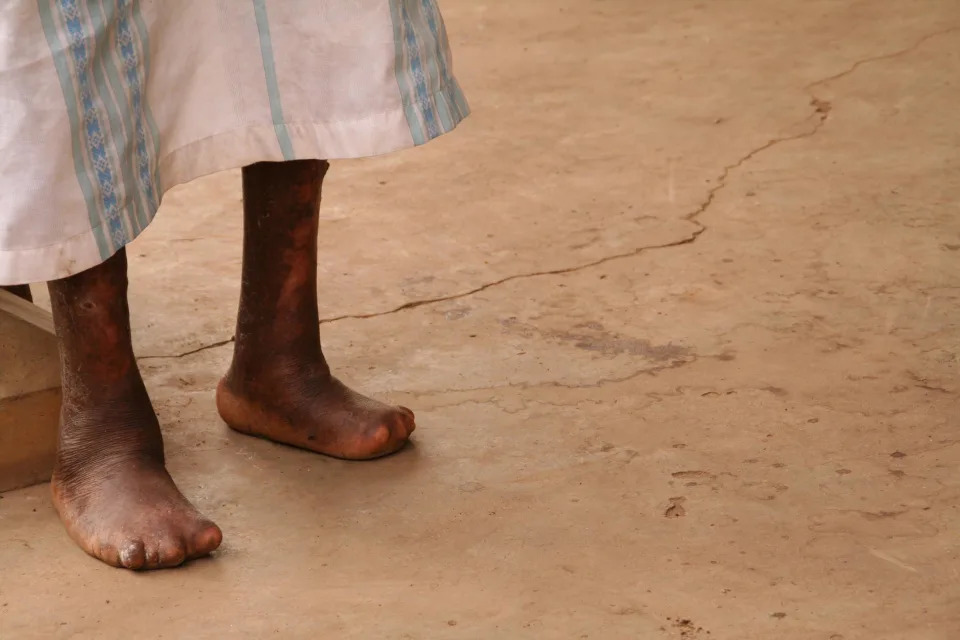 Disfigured feet on someone with leprosy. (Shutterstitch / Getty Images/ iStockphoto)
