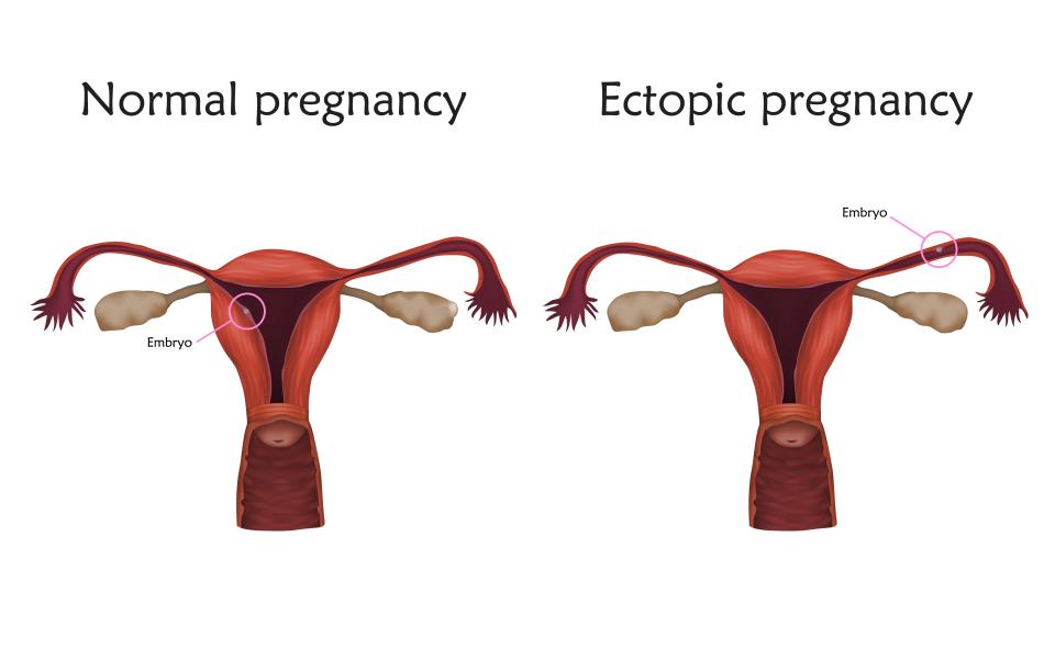 Ectopic and normal pregnancy, illustration. In an ectopic pregnancy the embryo implants in the fallopian tube, not in the uterus.