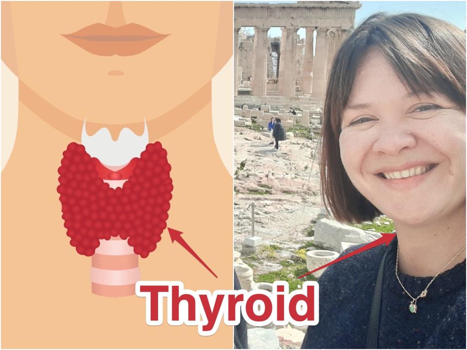 Images side by side show an anatomical illustration of the where the thyroid is in the body next to a picture of Marianne Guenot. An arrow points to the thyroid in both cases
