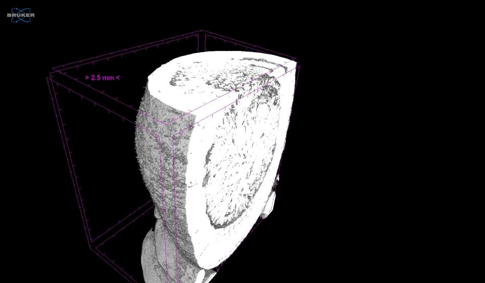 A black and white CT scan of the porcelain gallbladder and the gallstone within.