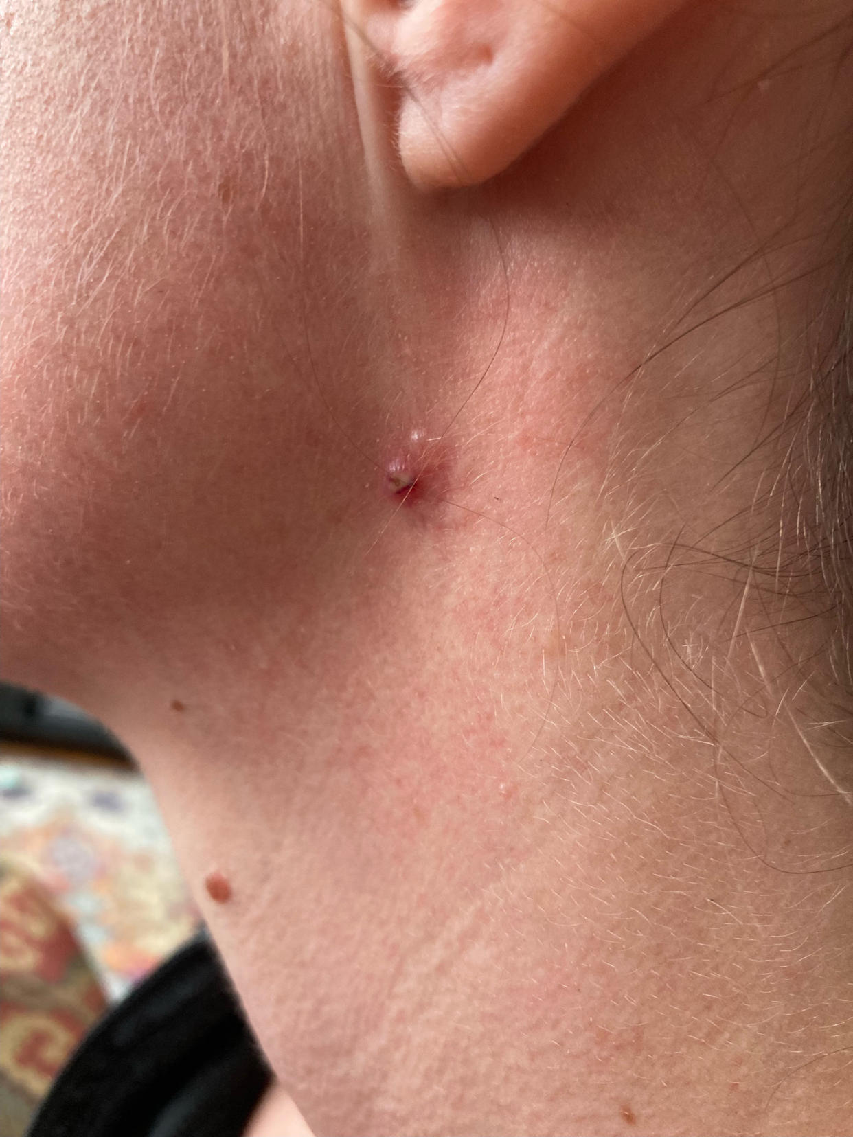 When Megan Fry woke up and saw her mole had changed she knew she needed to see a doctor immediately. (Courtesy Megan Fry)