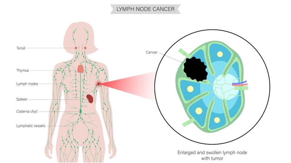 An illustration of lymphoma