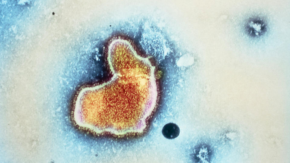 Colored transmission electron micrograph (TEM) of a respiratory syncytial virus (RSV).