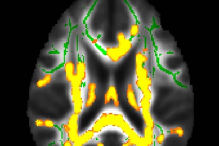 This image showed increased neuroinflammation (yellow colors) with higher hidden fat in the brain's white matter in the cohort of participants with an average age of 50 years. The green colors are normal white matter. Photo by Dr. Mahsa Dolatshahi/Radiological Society of North America