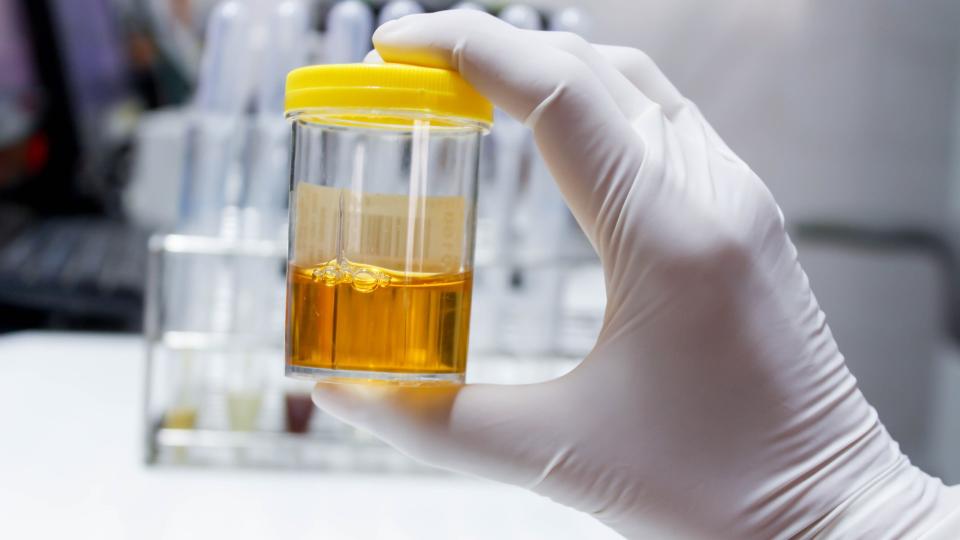 Close-up of a hand wearing a lab glove holding up a sealed see-through container containing a sample of urine