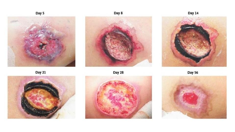 Images of lesions from a brown recluse spider bite over the course of 56 days. (Bitten by Brown Recluse Spider_The New England Journal of Medicine ©2013)