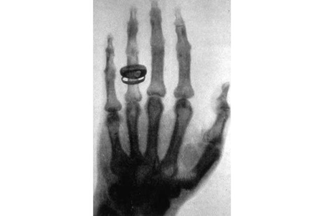 Radiografía de Rayos X tomada por Wilhelm Röntgen en 1896