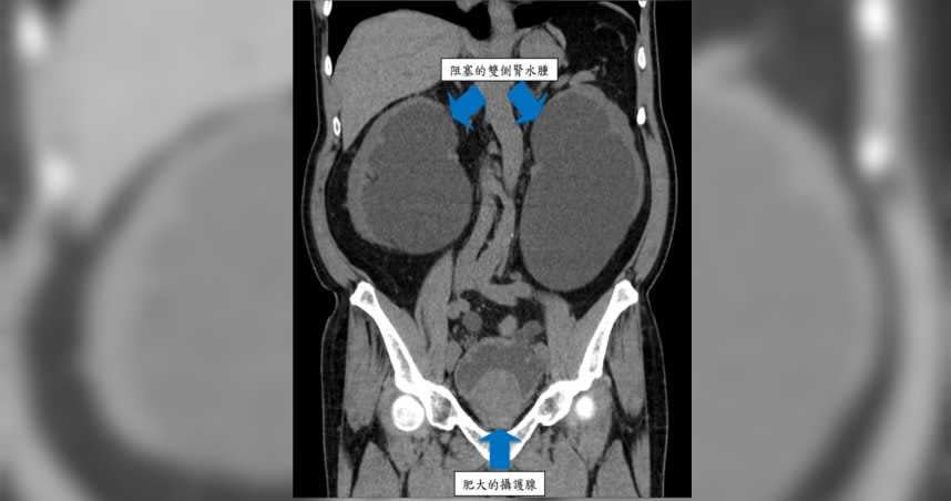 電腦斷層檢查顯示，患者攝護腺肥大導致兩邊嚴重腎水腫。（圖／北市聯合醫院提供）