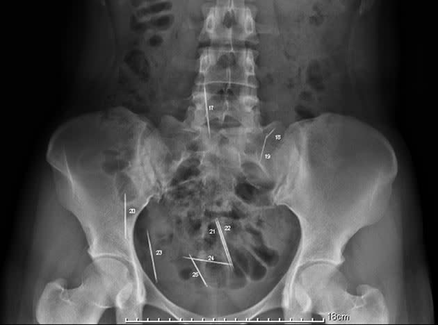 Shocking X-Rays