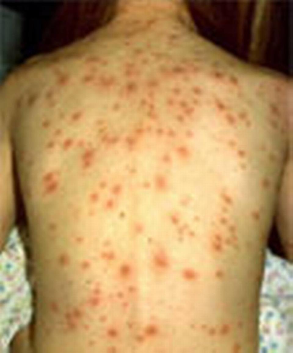 An unvaccinated case of Chickenpox spread across the back.