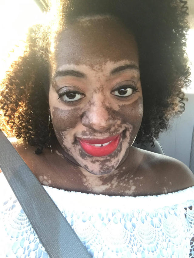 Bride Developed Vitiligo Before Her Wedding 2966