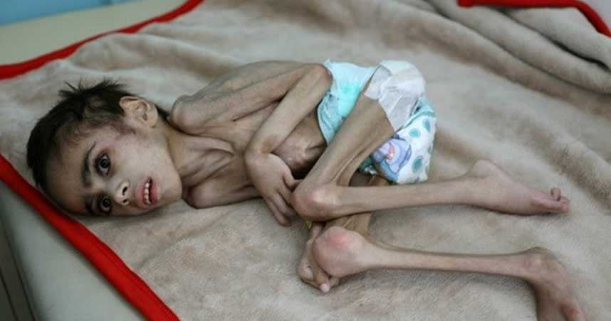 葉門7歲男童費德（Faid Samim）嚴重營養不良，已經7歲的他，體重7公斤。（圖／路透）