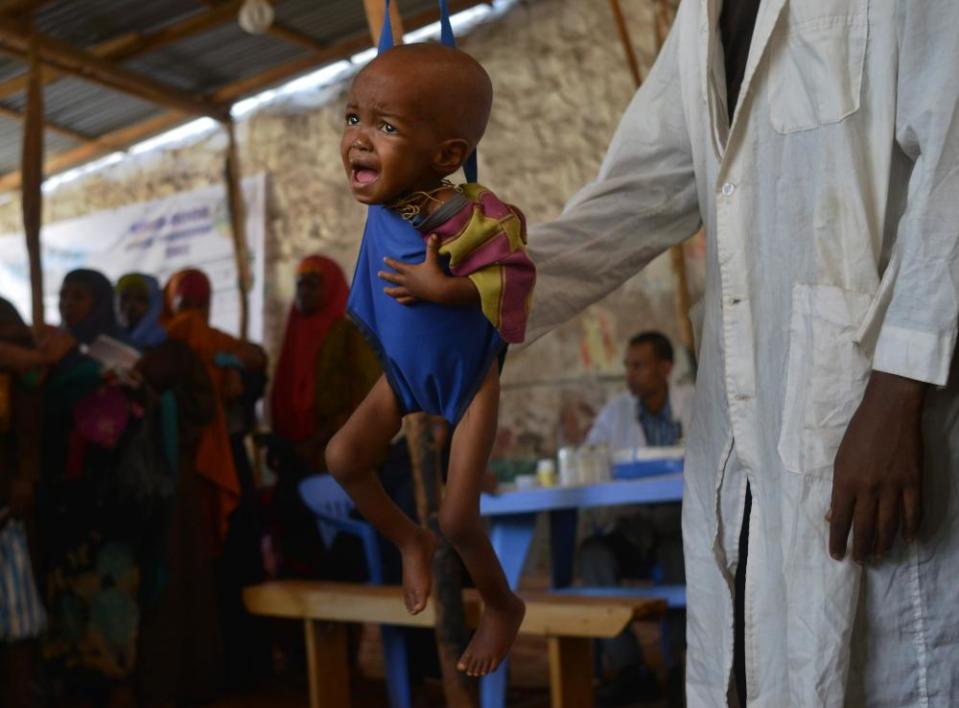 A malnourished child is weighed by an aid worker at a facility in Baidoa.