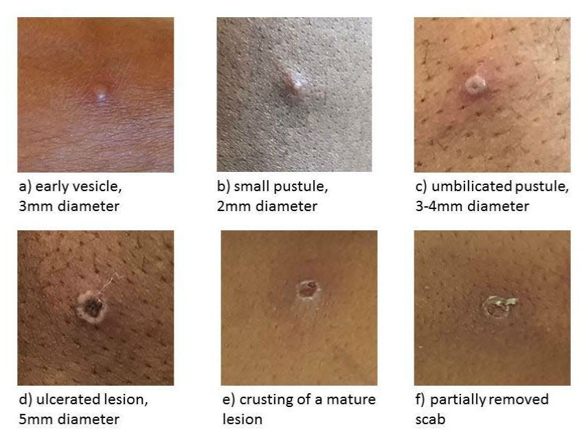 monkeypox lesions on different skin tones