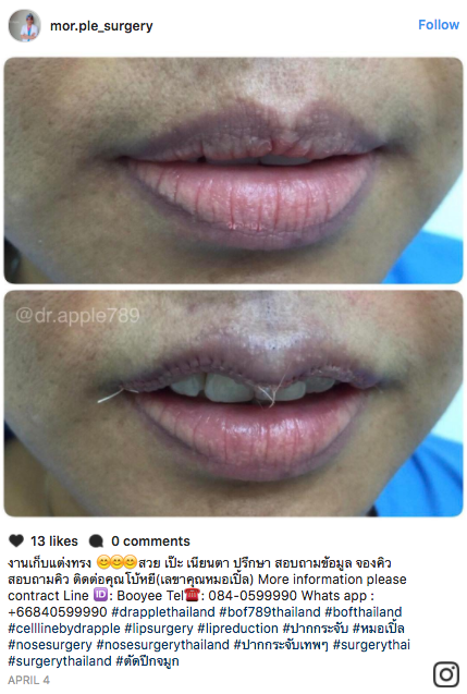 Lip reduction surgery, which involves cutting the lips to reduce their size, is attracting attention on social media.