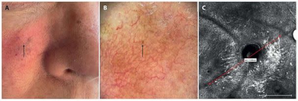 PHOTO: The small spot that was determined to be skin cancer is shown in photos of Christy Staats. (Courtesy of Oregon Health & Science University)