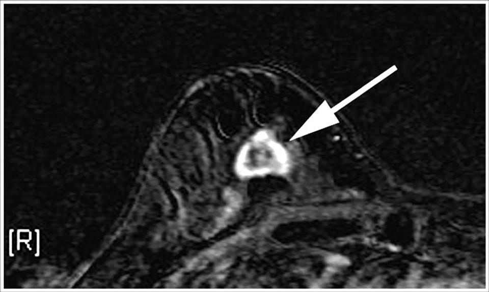 FILE - This undated file image provided in 2007 by the Duke University Department of Medicine shows a right breast MRI from a 55-year-old woman with extreme breast density. The superimposed arrow points to a 2 cm rapidly enhancing lesion which was later confirmed by biopsy to be invasive breast cancer. Doctors have successfully dropped the first "smart bomb" on breast cancer, using a drug to deliver a toxic payload to tumor cells while leaving healthy ones alone, doctors plan to report Sunday, June 3, 2012. (AP Photo/Duke University Department of Medicine, File)