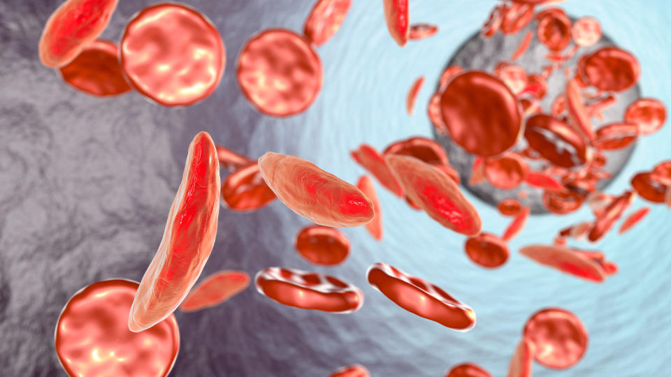 Artwork showing normal red blood cells (round), and red blood cells affected by sickle cell anaemia (crescent shaped)