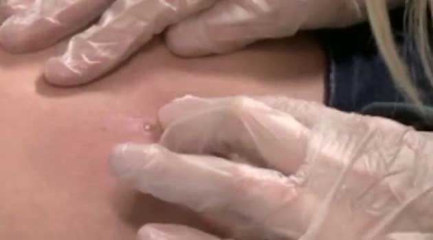 Catherine Stewart discovered she was harbouring flesh-eating maggots when she attempted to open a red lesion on her stomach. Photo: Discovery