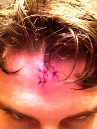 Madison wrestler Mike McCormish's injuries from a light fixture accident on Friday — Twitter