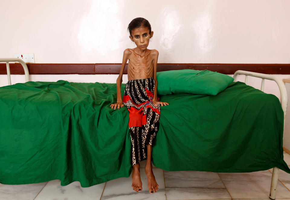 Fatima Ibrahim Hadi, 12, who is malnourished and weighs just 10kg, sits on a bed at a clinic in Aslam, in the northwestern province of Hajjah, Yemen, February 17, 2019.