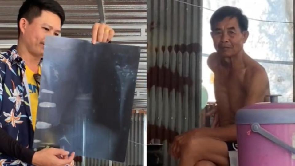 泰國老翁的X光片曝光肺卡42顆子彈。（圖／翻攝自TikTok@chanakan355）